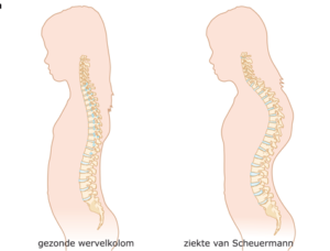 afbeelding_scheuermann